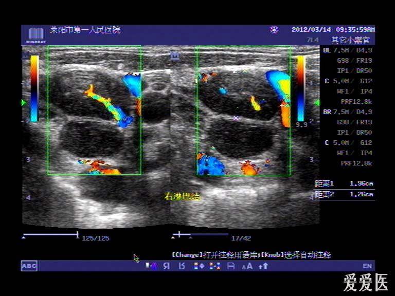 看图请帮忙会诊:淋巴瘤 超声医学讨论版 爱爱医医学论坛