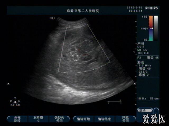 胎盘海绵状血管瘤 超声医学讨论版 爱爱医医学论坛