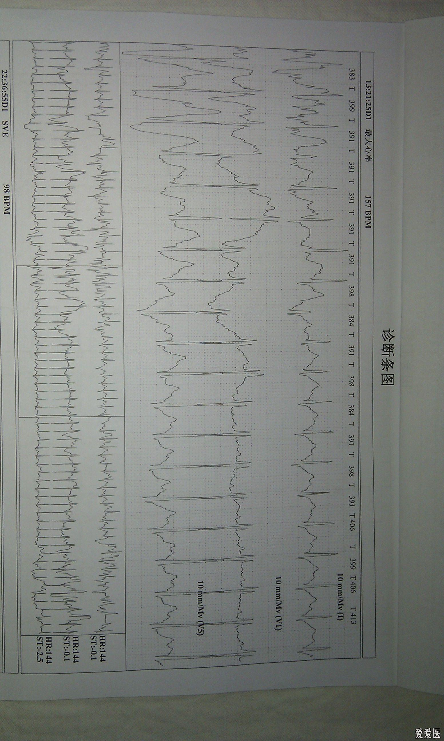 胸口闷痛,24小时心电图示最高心律157,正常么?鲜花送上