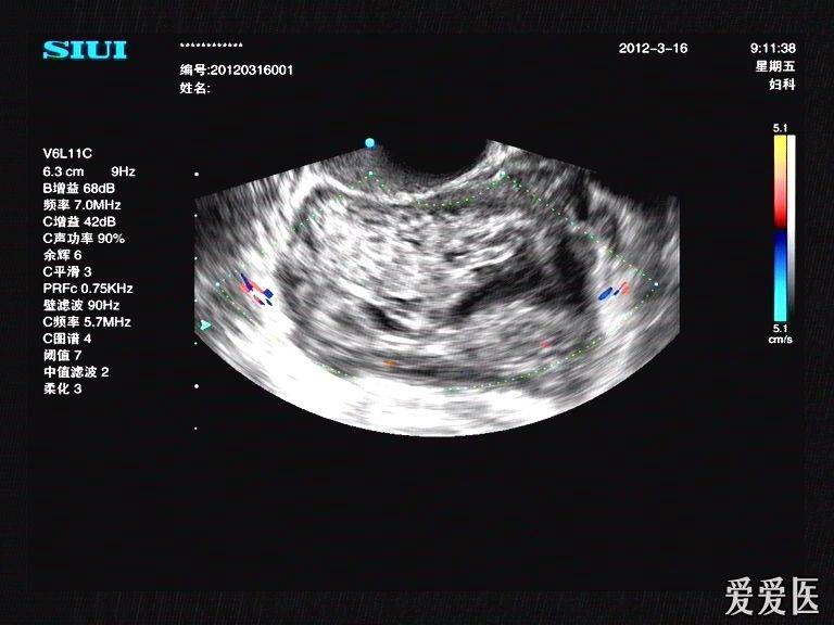 宫外孕破裂型包块