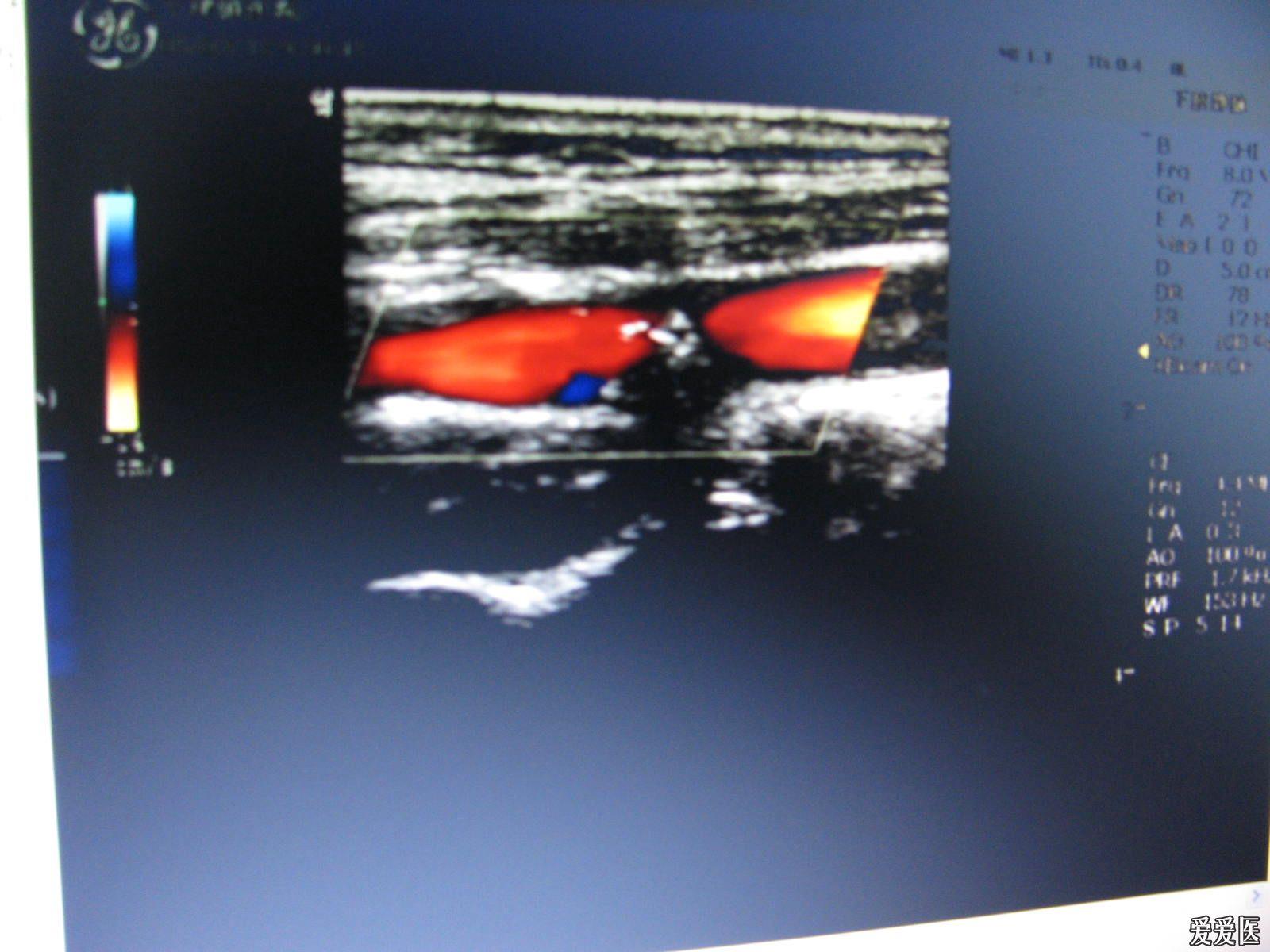 颈动脉斑块超声图片图片