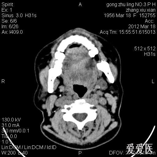 鼻前庭囊肿一例分享!