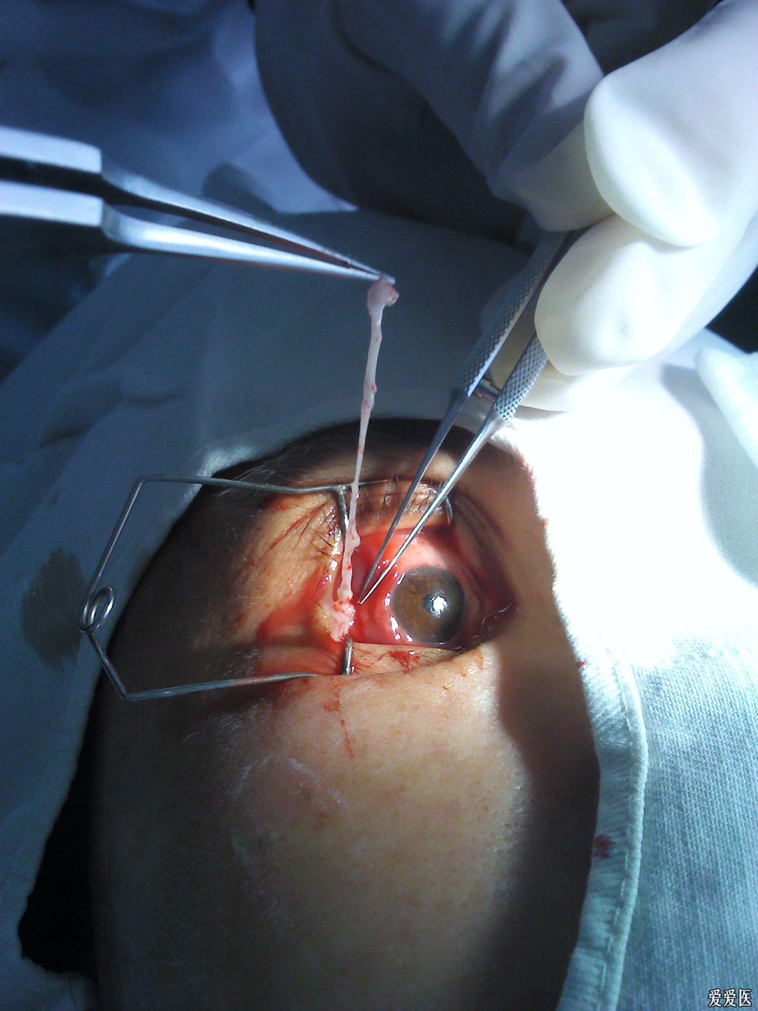 球结膜寄生虫误诊