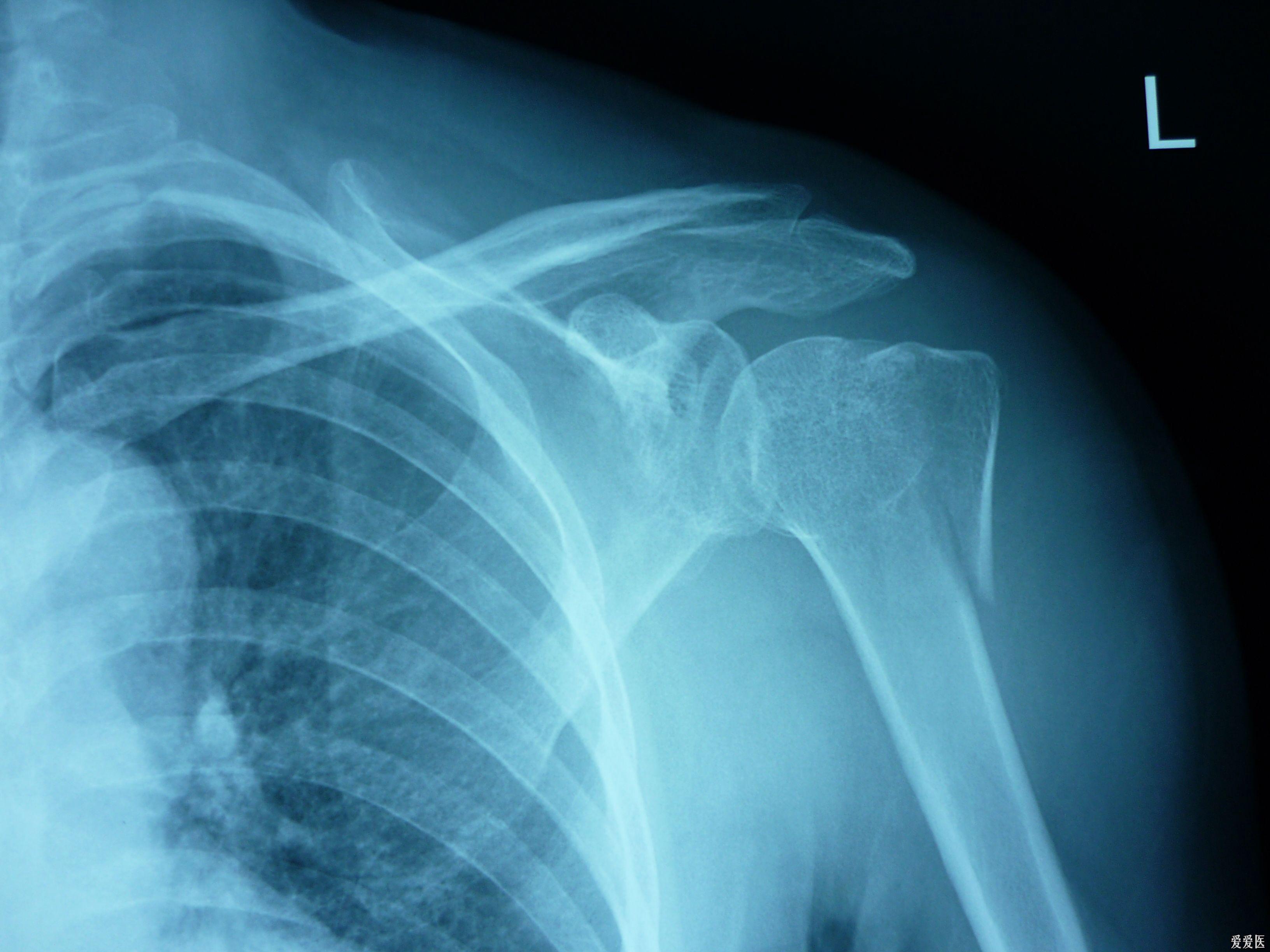 PHILOS钢板结合肩袖加强缝合治疗肱骨近端Neer Ⅳ型骨折临床疗效分析|肱骨头|肱骨|骨折|关节|结节|骨块|-健康界