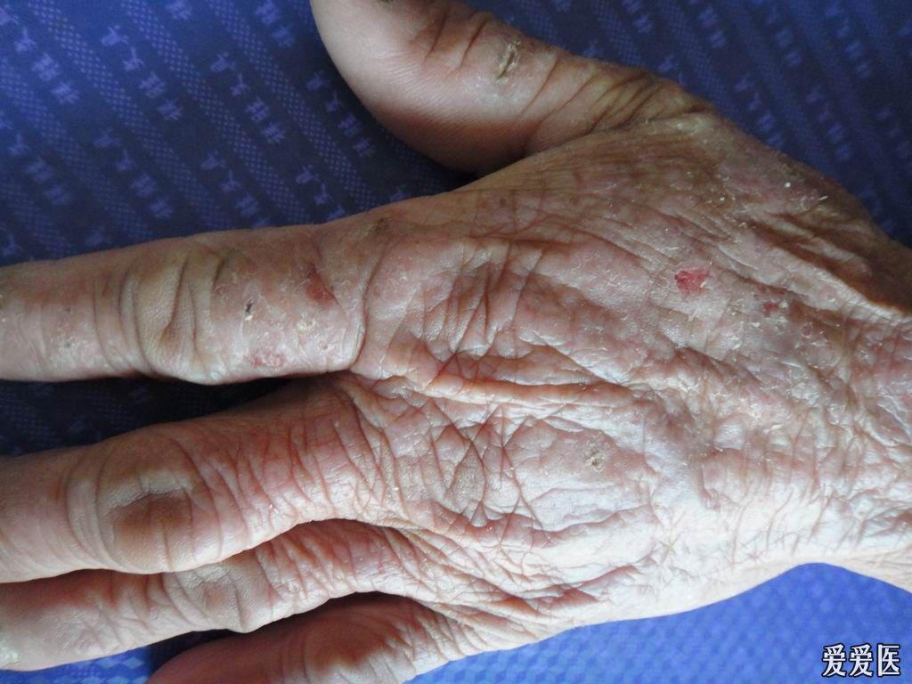 看图诊断62慢性光化性皮炎