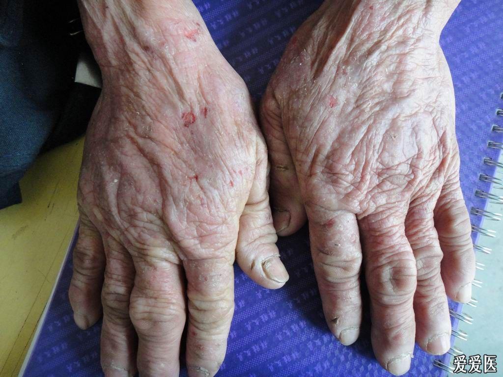 看图诊断62慢性光化性皮炎