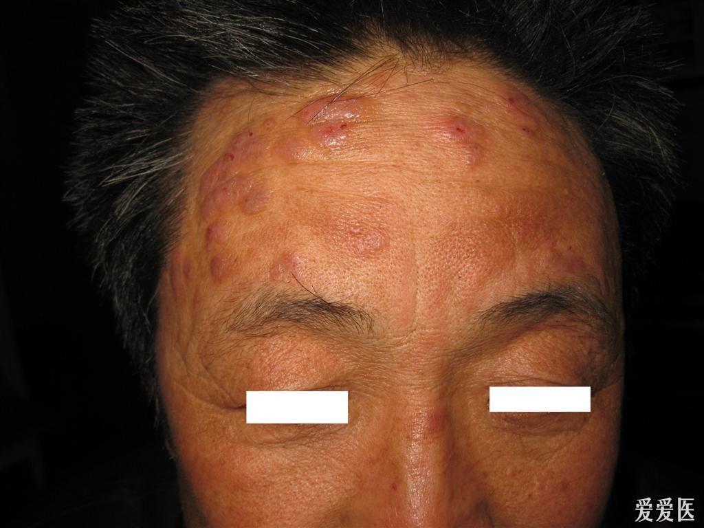 看图识病------------------泛发性痒疹 - 皮肤及性传播疾病讨论版