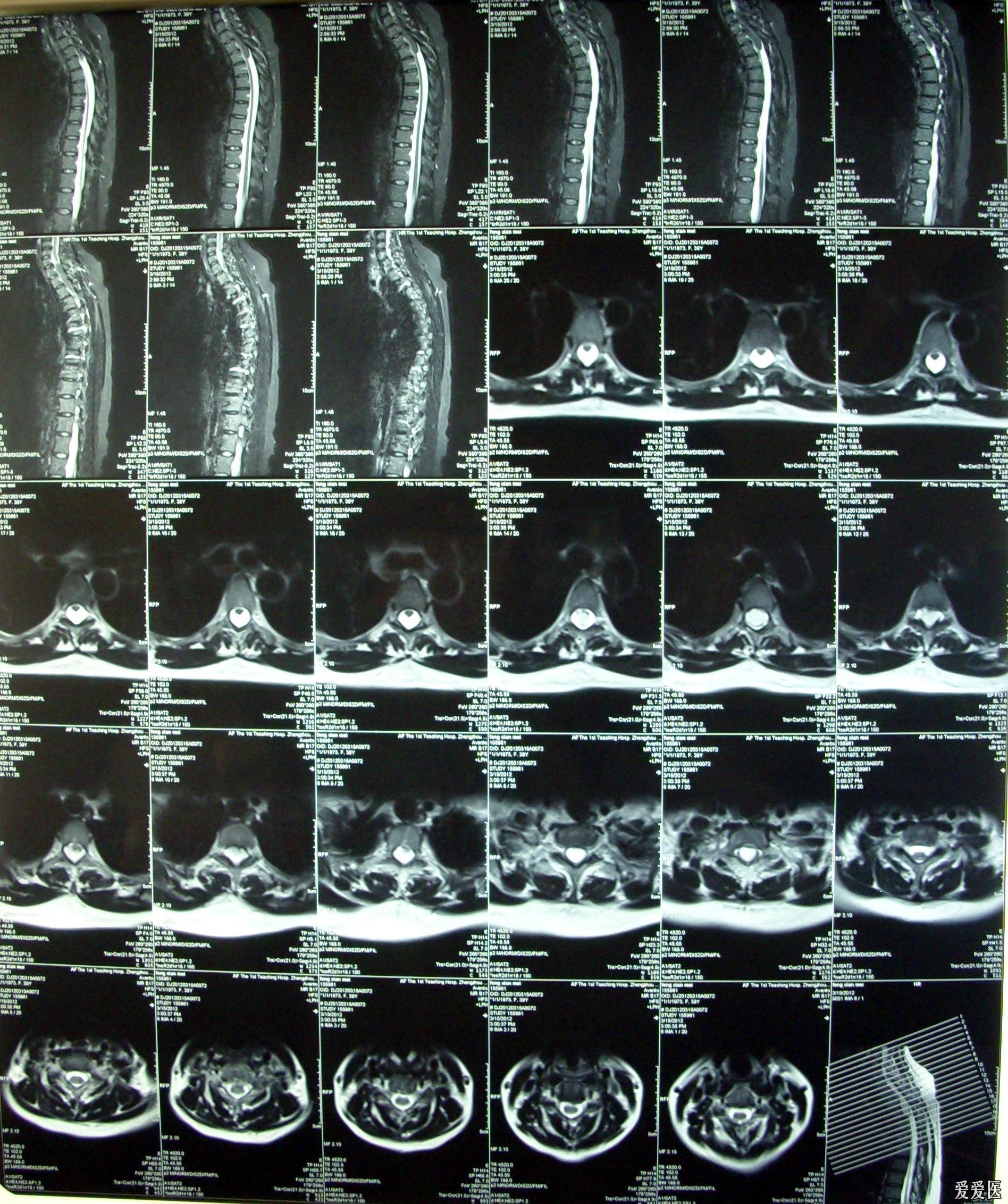 椎管内骨性占位图片图片