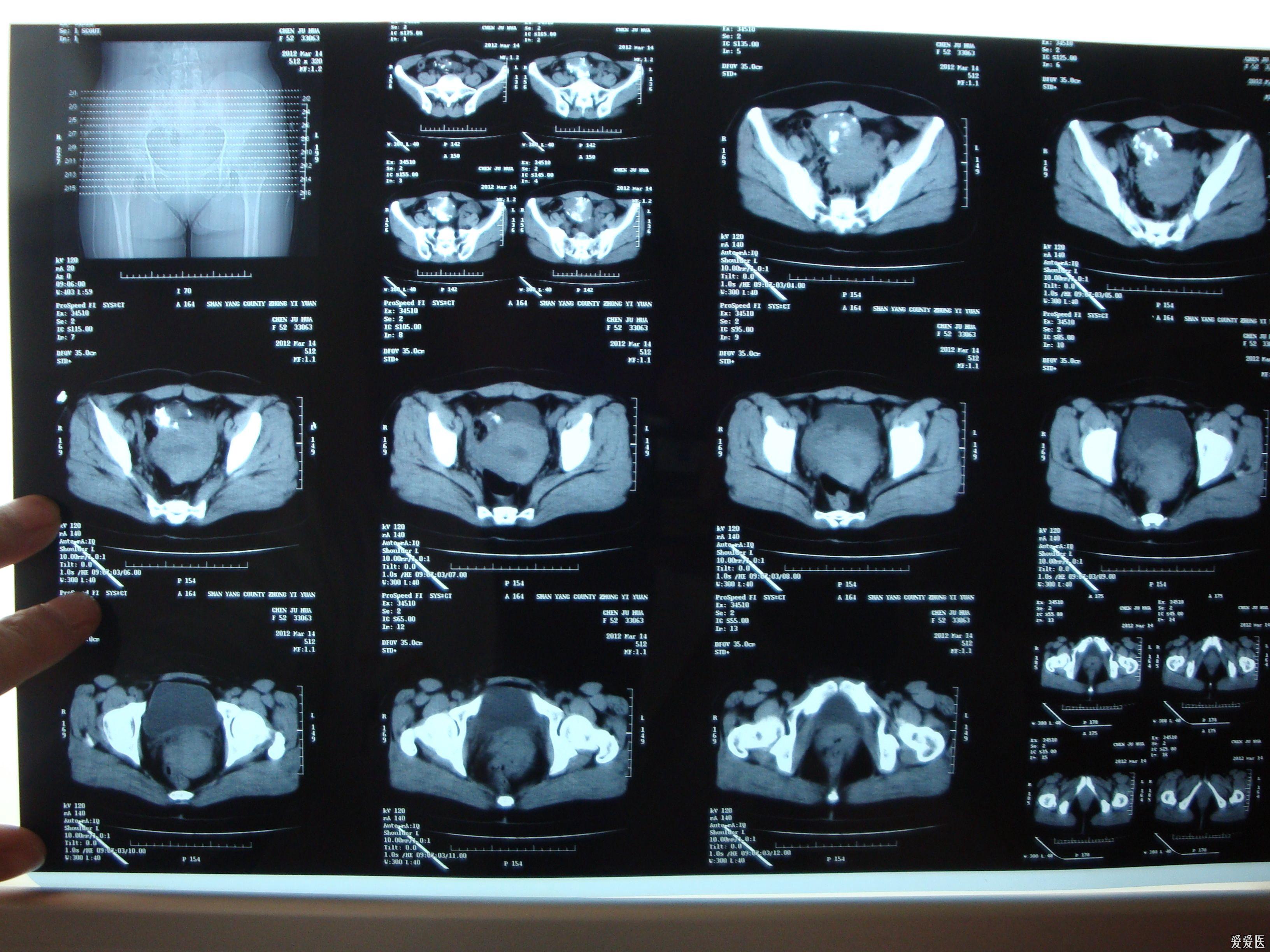 一例阑尾炎手术探查发现右侧附件包块