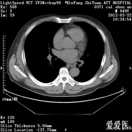 颈部纵膈脂肪瘤