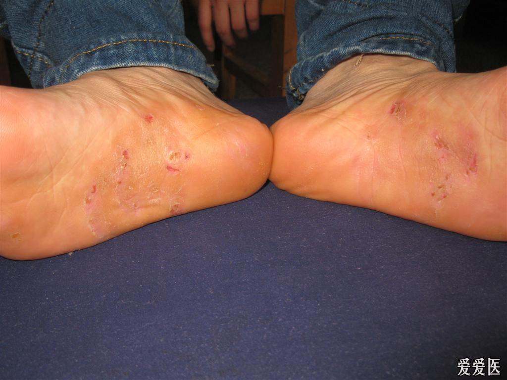 脚底湿疹怎么治图片