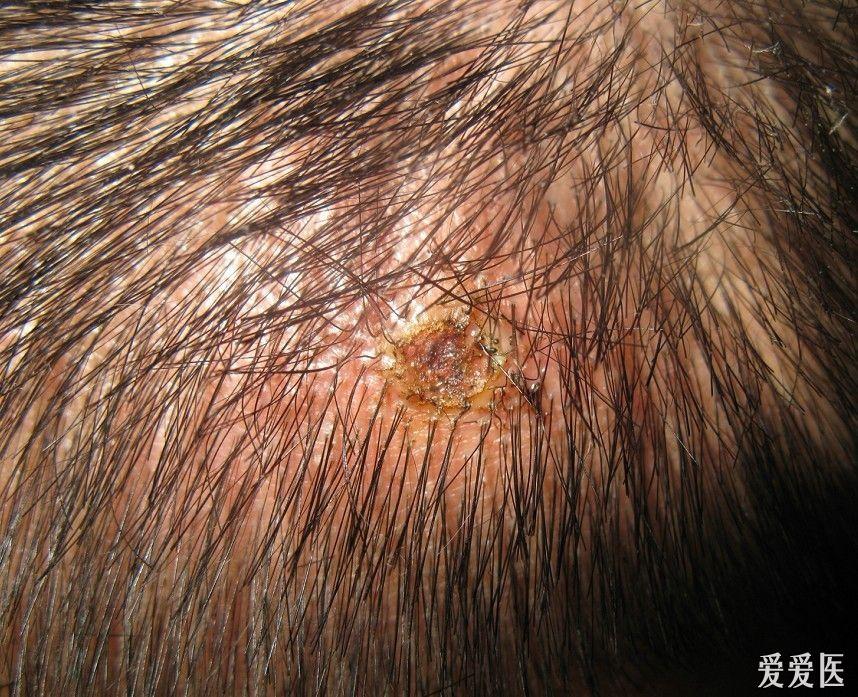 头皮化脓性肉芽肿