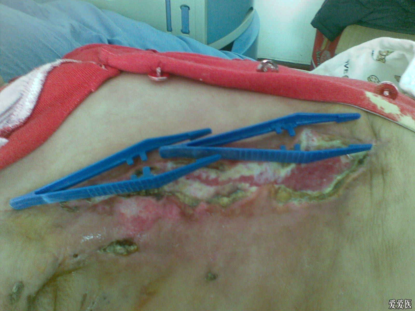 乳腺纤维瘤图片伤口图片
