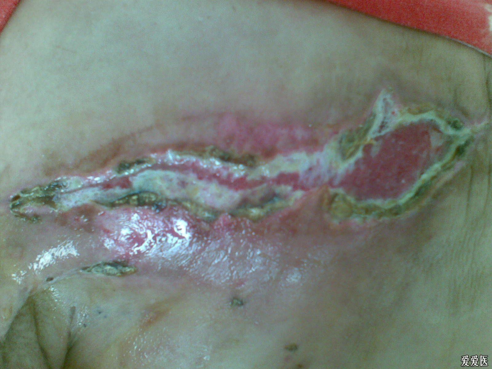 胸前手术伤口疤痕图片图片