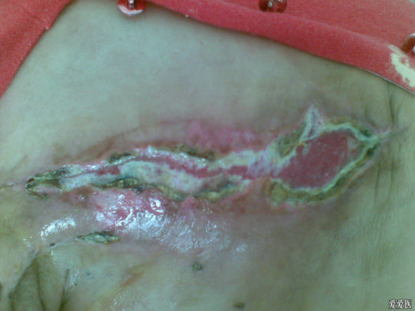 乳房棒棒糖切口疤痕图片