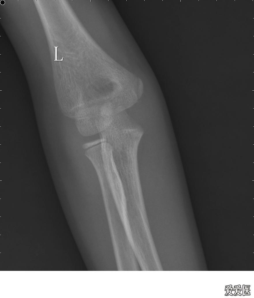13岁肘关节正常x光片图片