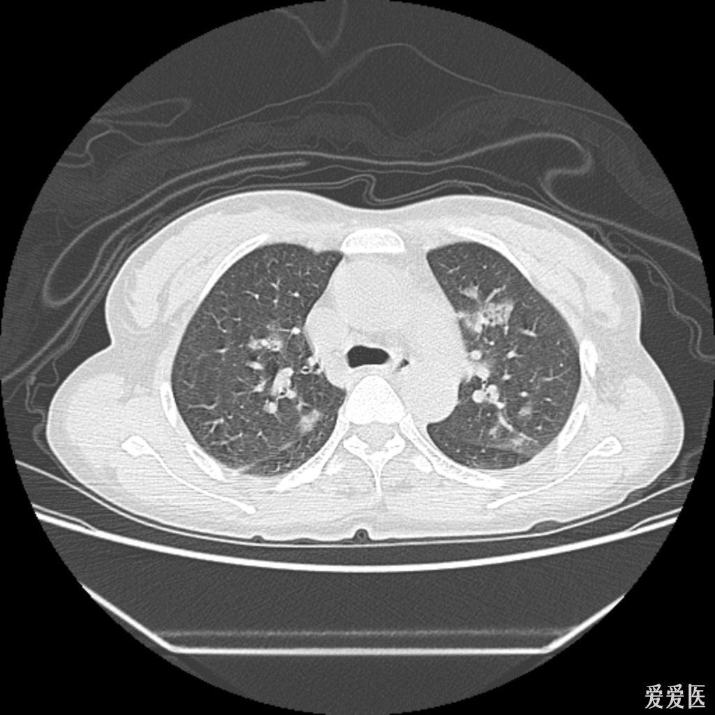 肺部真菌感染ct