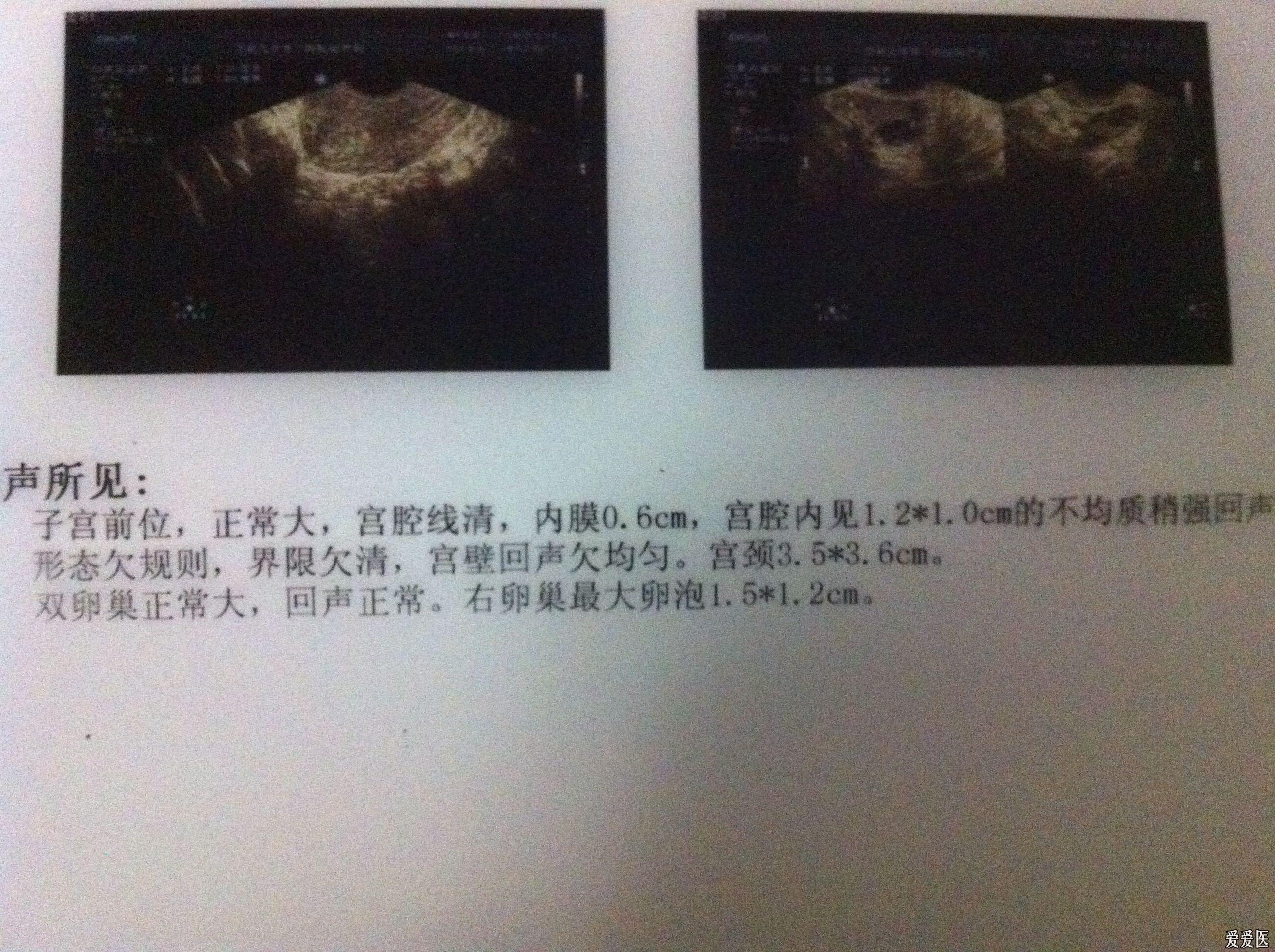 子宫内膜薄的彩超图片图片