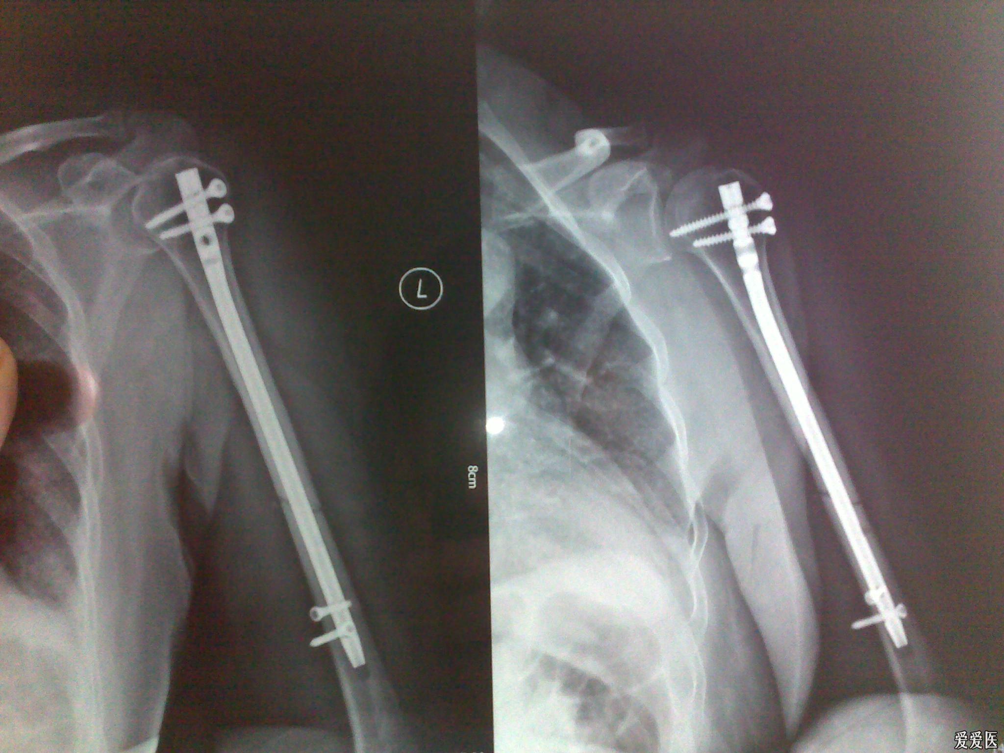 肱骨髓内钉的开口位置图片