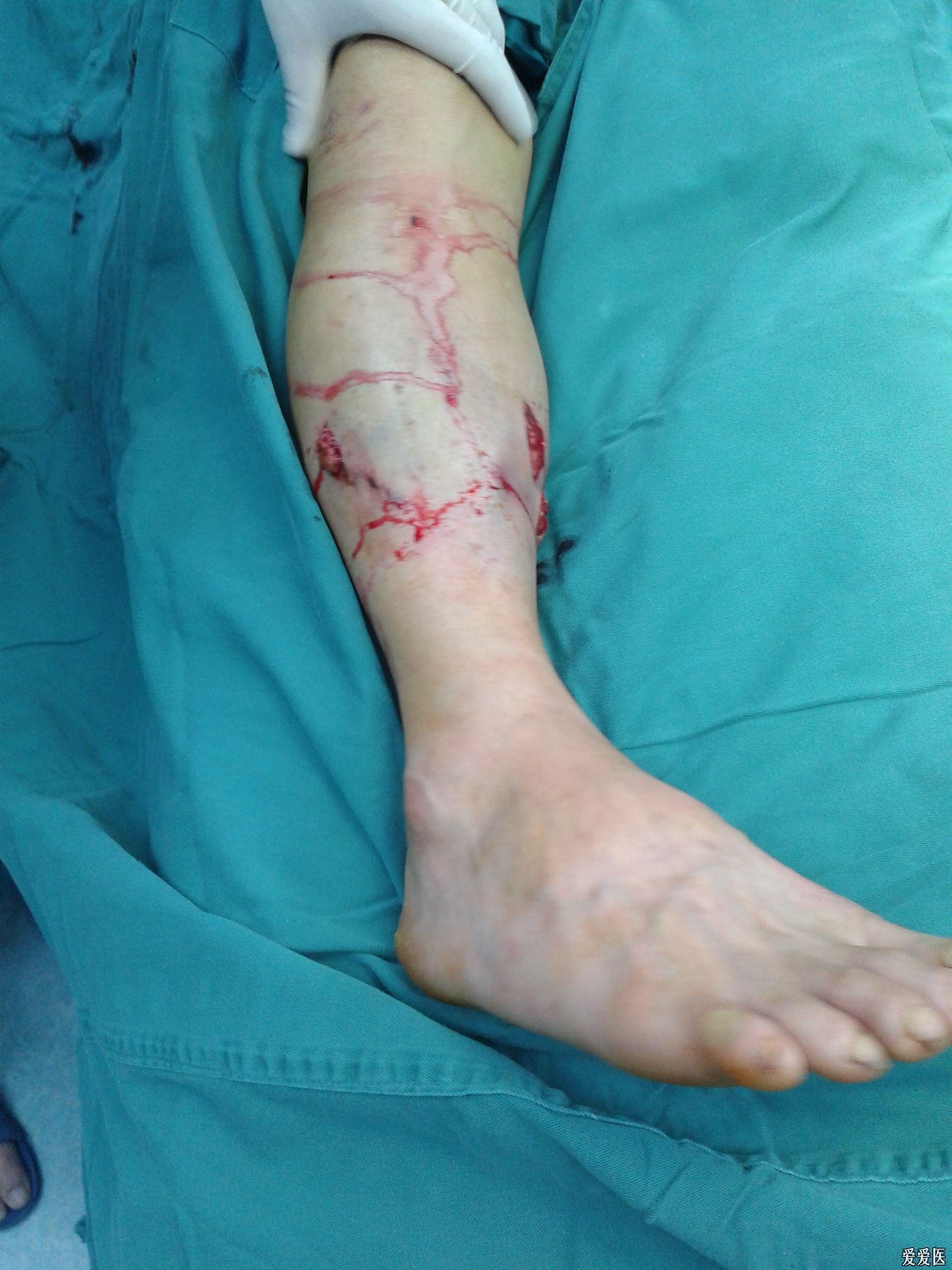 胫骨外固定支架请大家指正