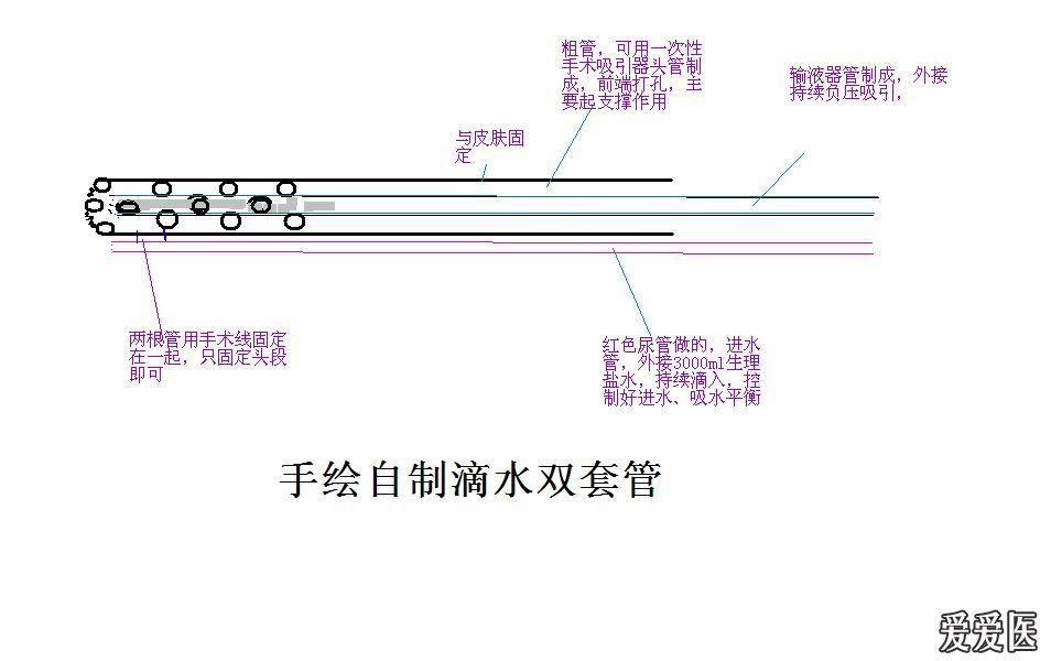 临床上关于【滴水双套管】的知识