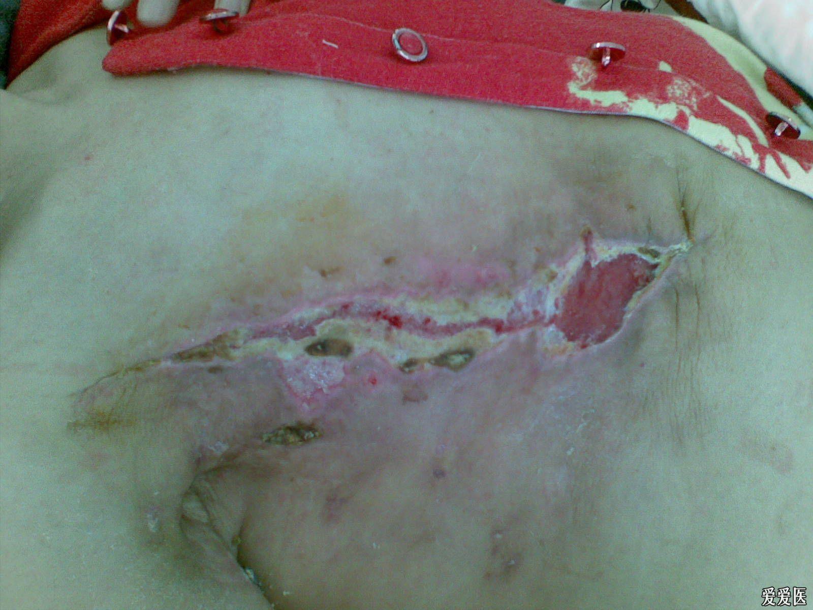 乳腺结节手术刀口图片图片