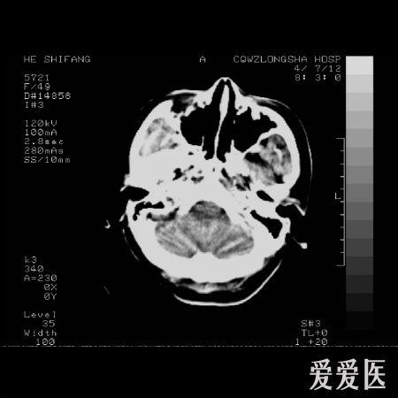 急ct平扫病例，请教高手