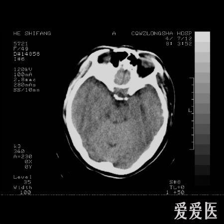 急ct平扫病例，请教高手