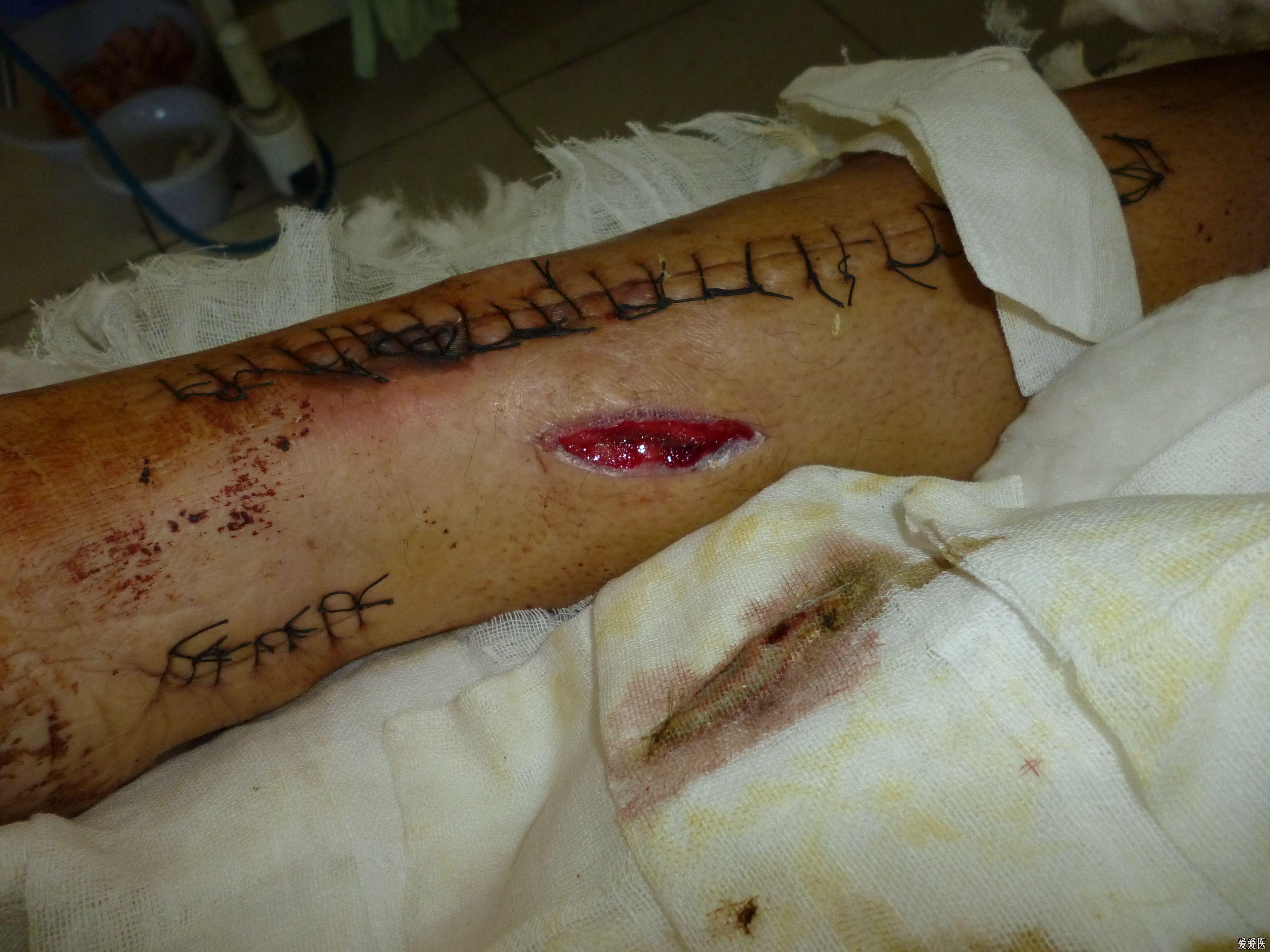 胫腓骨骨折内固定