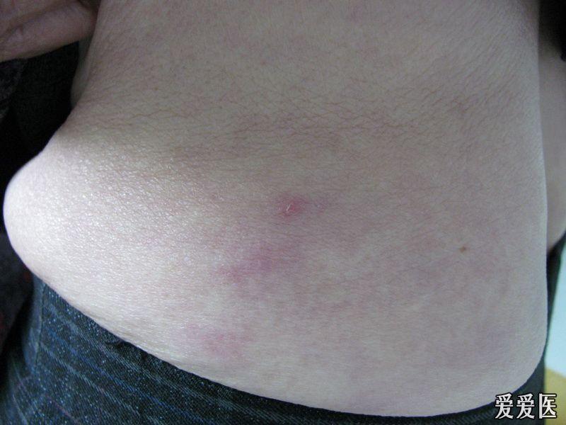 结节性红斑早期图片图片