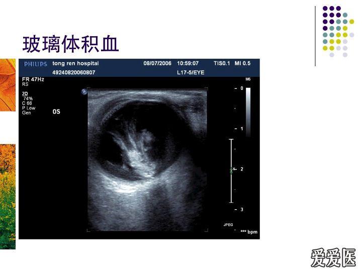 玻璃体积血 - 超声医学讨论版 - 爱爱医医学论坛