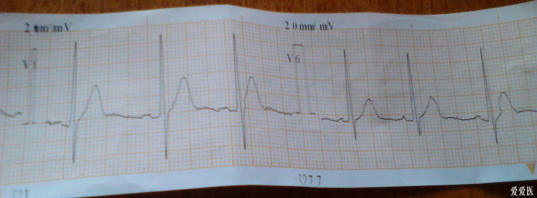 这个胸导联心电图怎么看呢