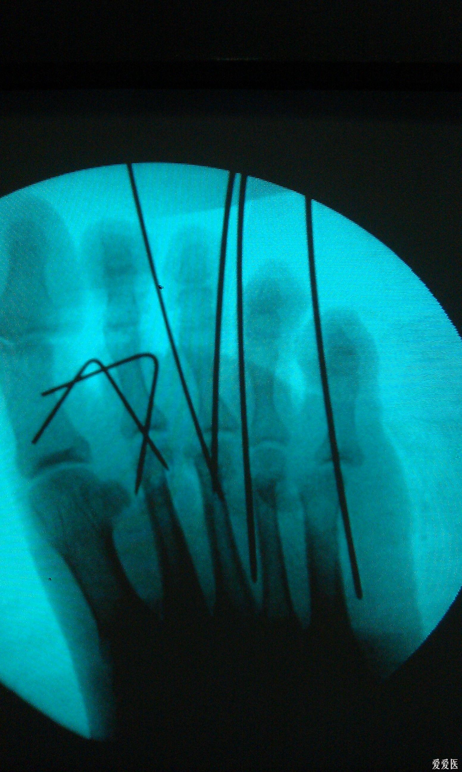 右足第二跖骨骨折图片图片
