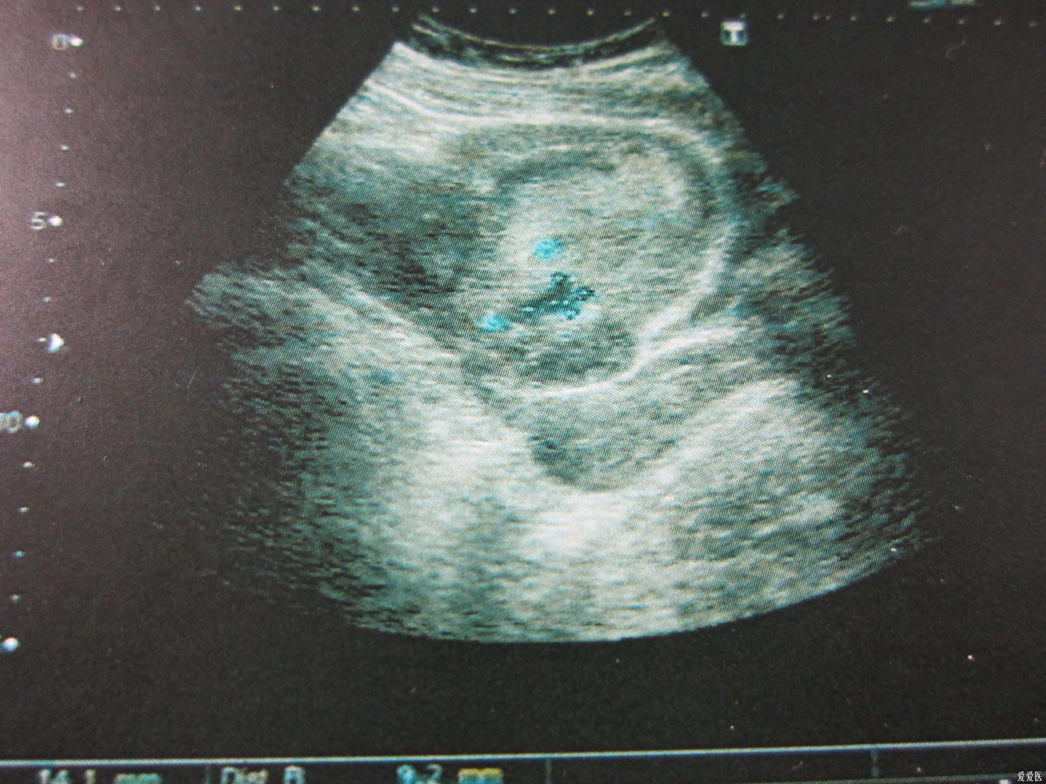 胎儿脑膜脑膨出的图片图片