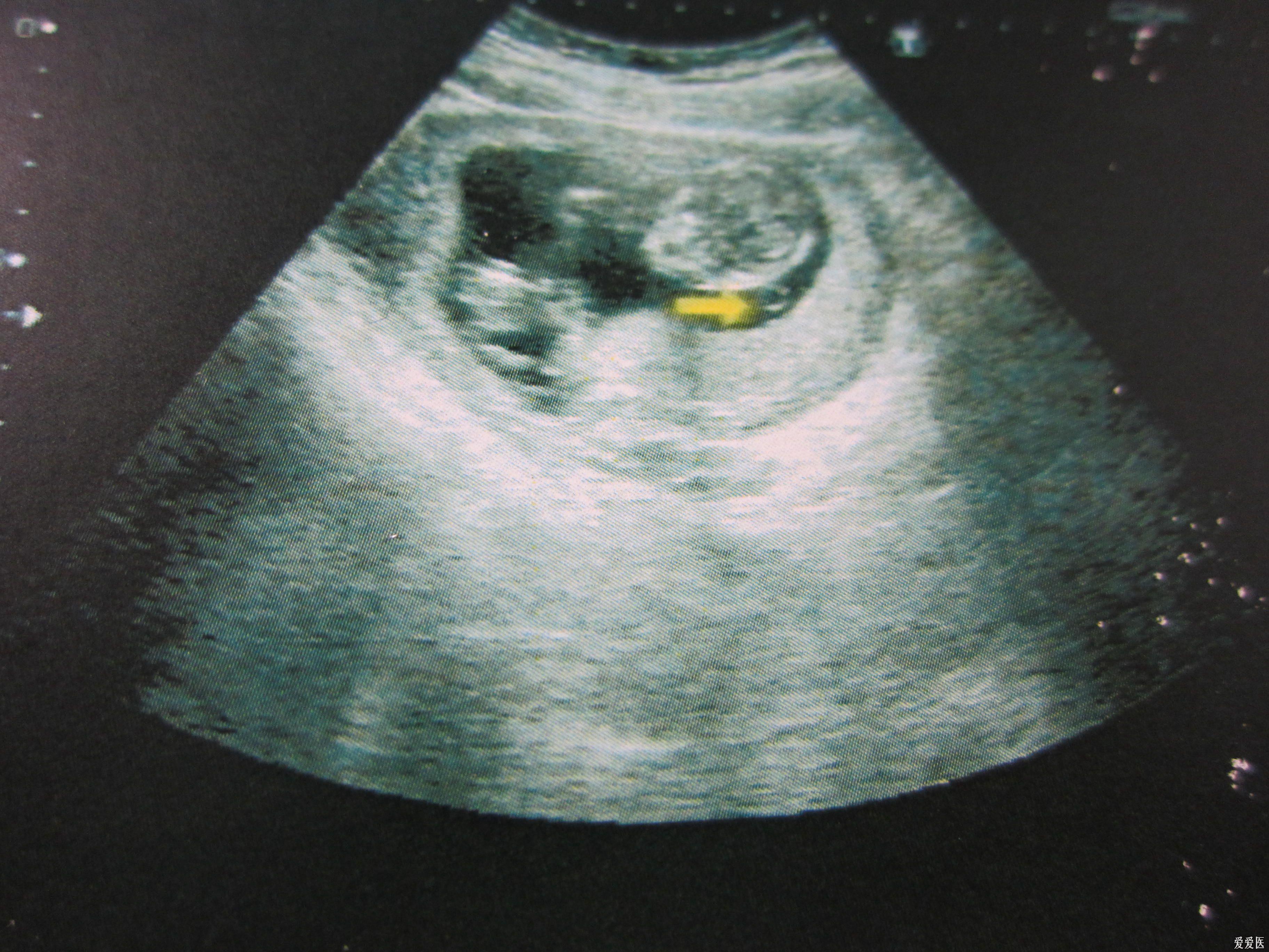 三个月胎儿脑膨出图片图片