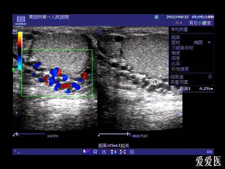 典型病例分享附睾炎附睾囊肿精索静脉曲张两例