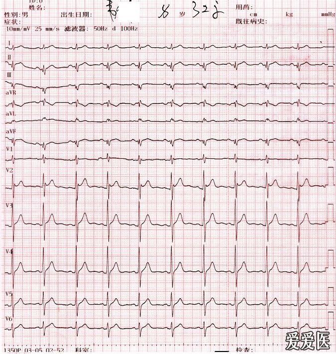 异常q波心电图表现图片