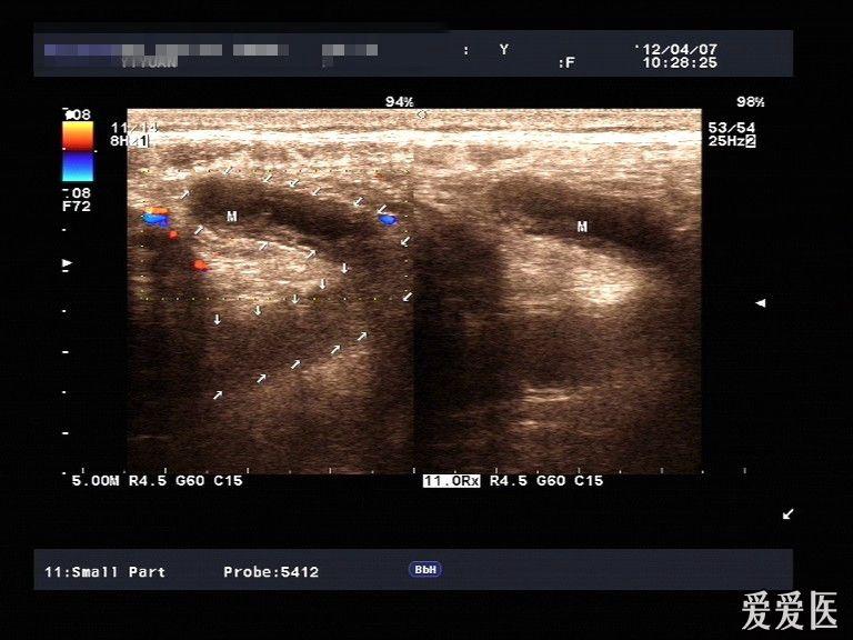 闌尾炎圖片集錦(不斷添加中.) - 超聲醫學討論版 - 愛愛醫醫學論壇