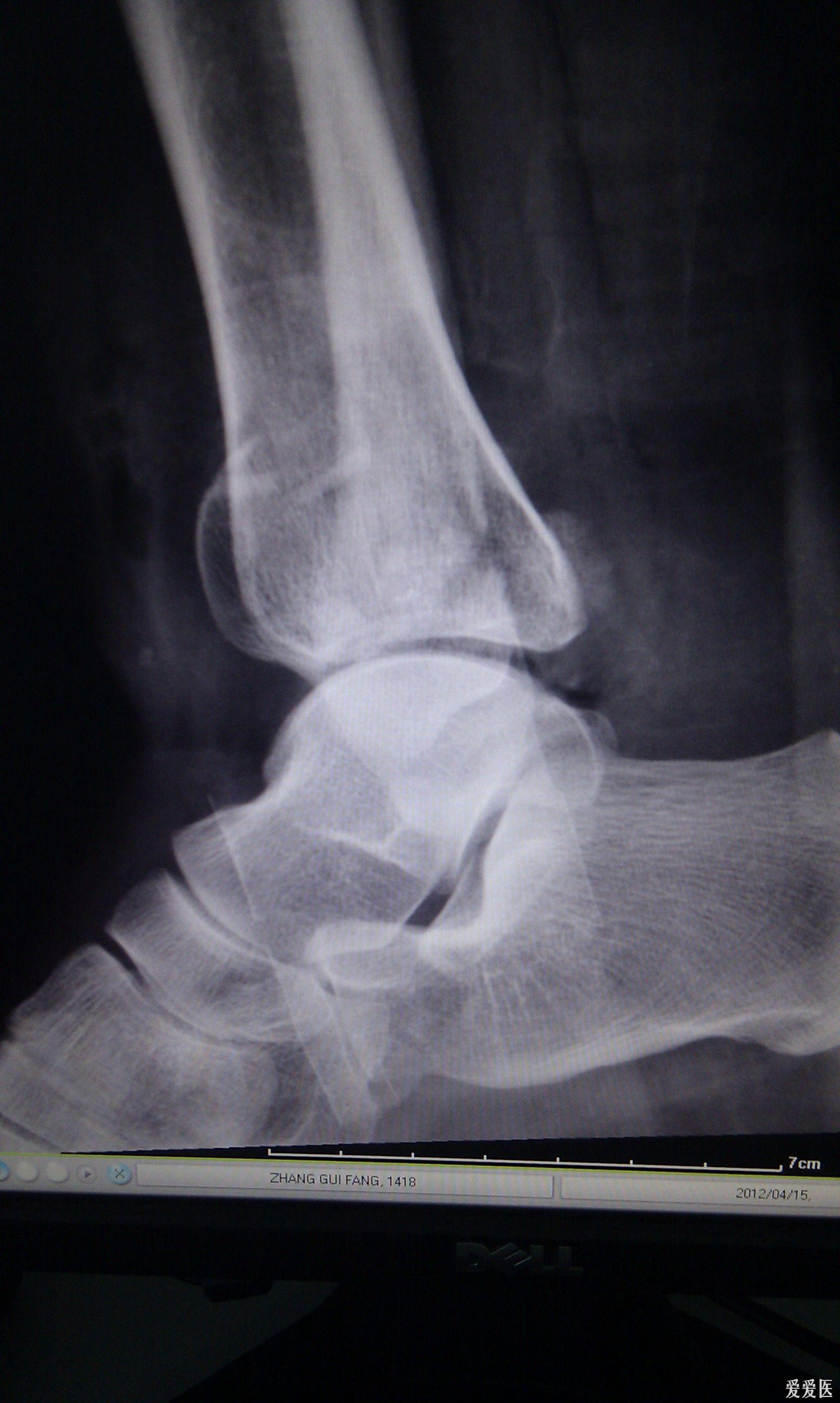 求助外伤ct胫骨pilon骨折合并踝关节半脱位