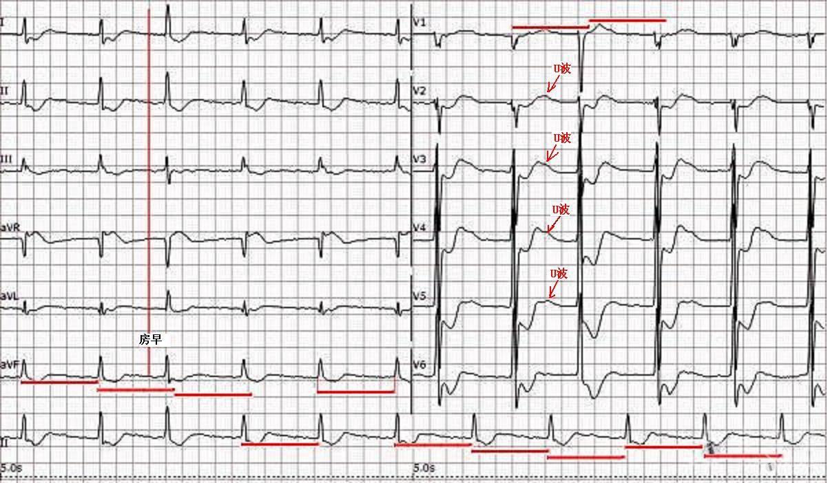 低血钙心电图图片