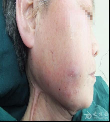颊粘膜恶性肿瘤图片图片