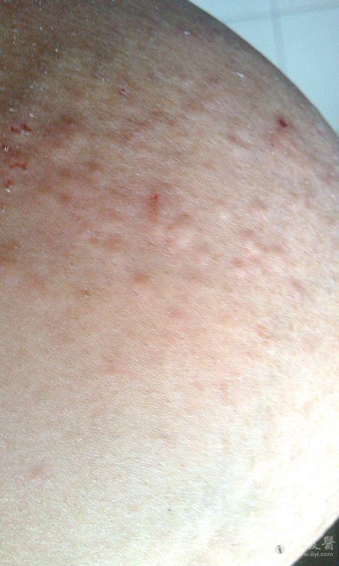 help求好心人帮忙看看我胸部长的这些疙瘩是什么呀