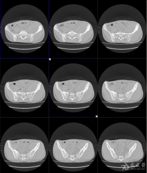 骨癌ct图片