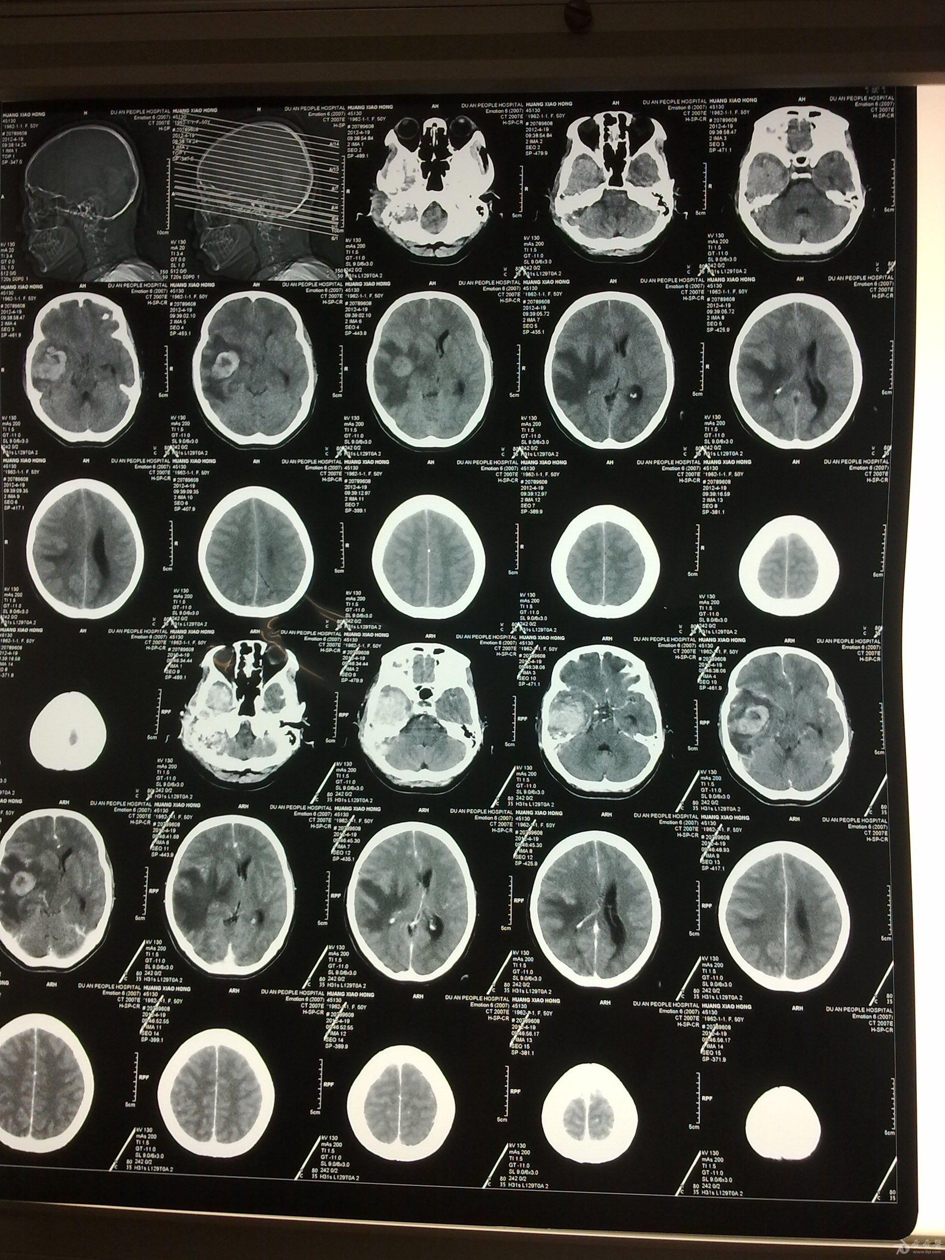 脑脓肿影像学表现图片