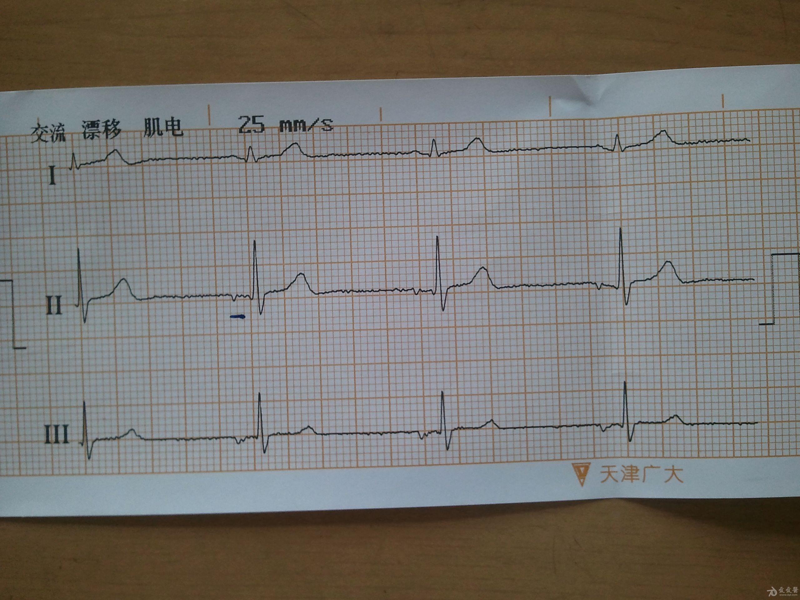 交界性自主心律心电图图片