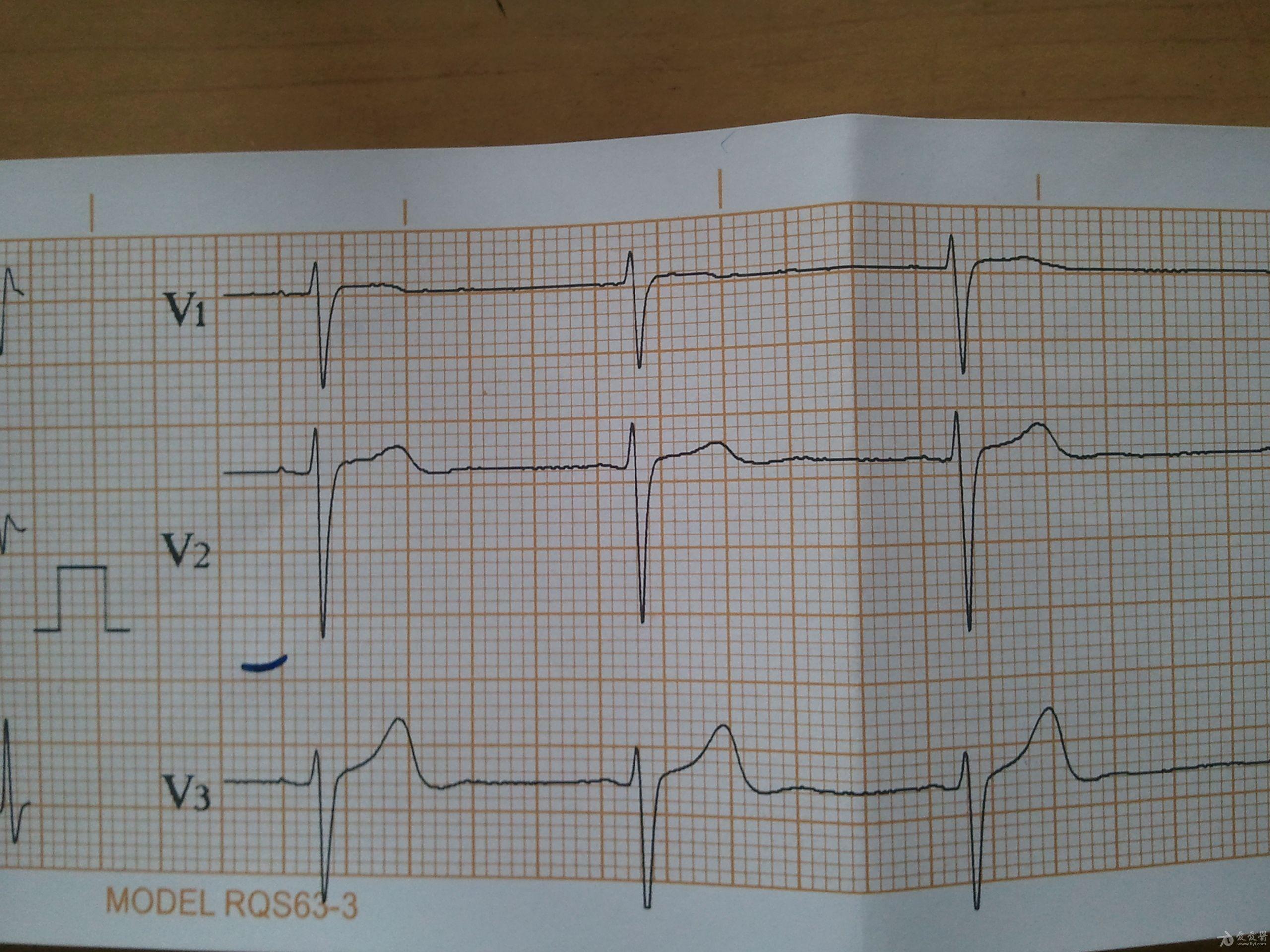 交界性自主心律心电图图片