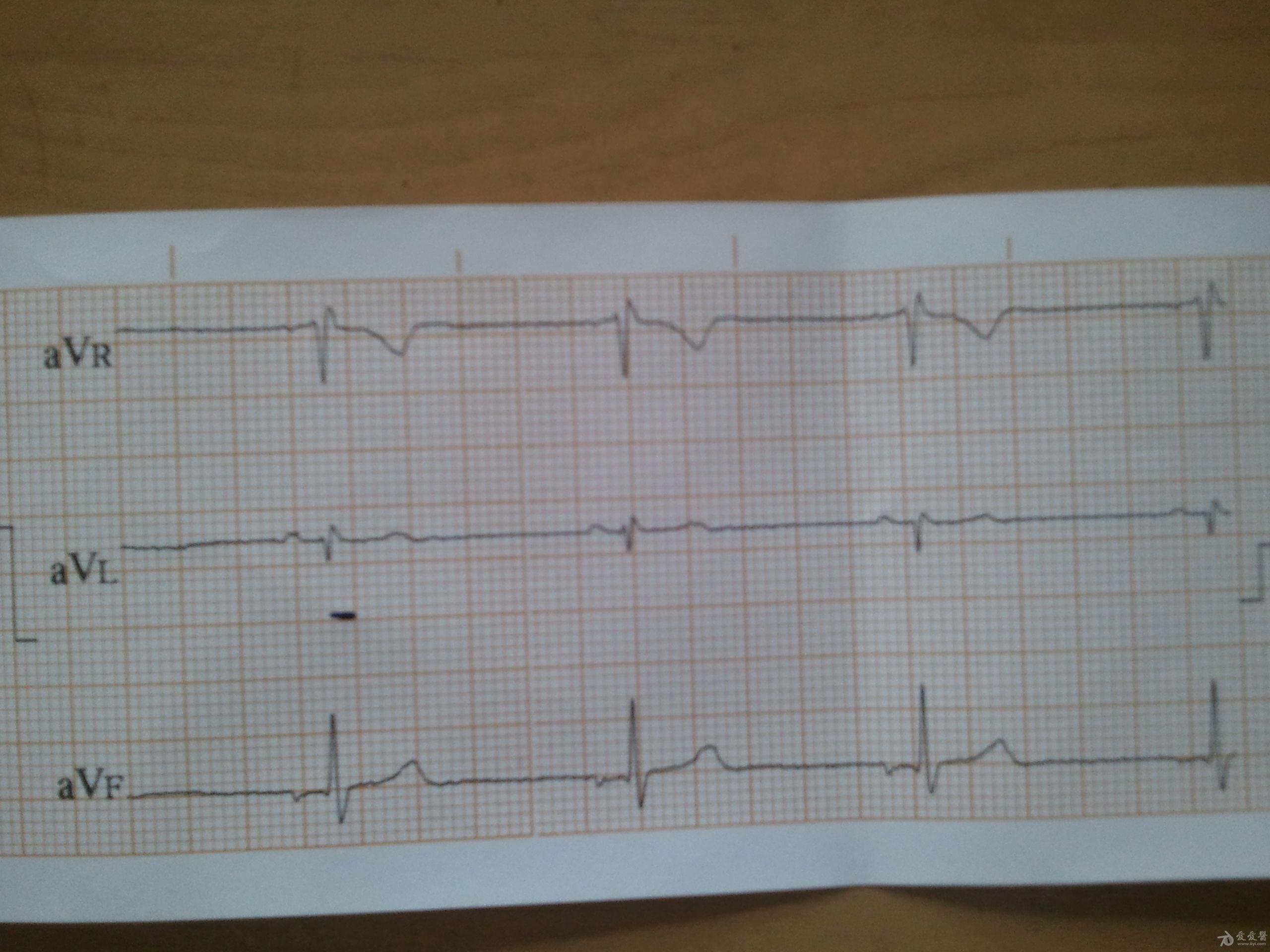看看是不是交界性心律 心电图脑电图专业讨论版 爱爱医医学论坛