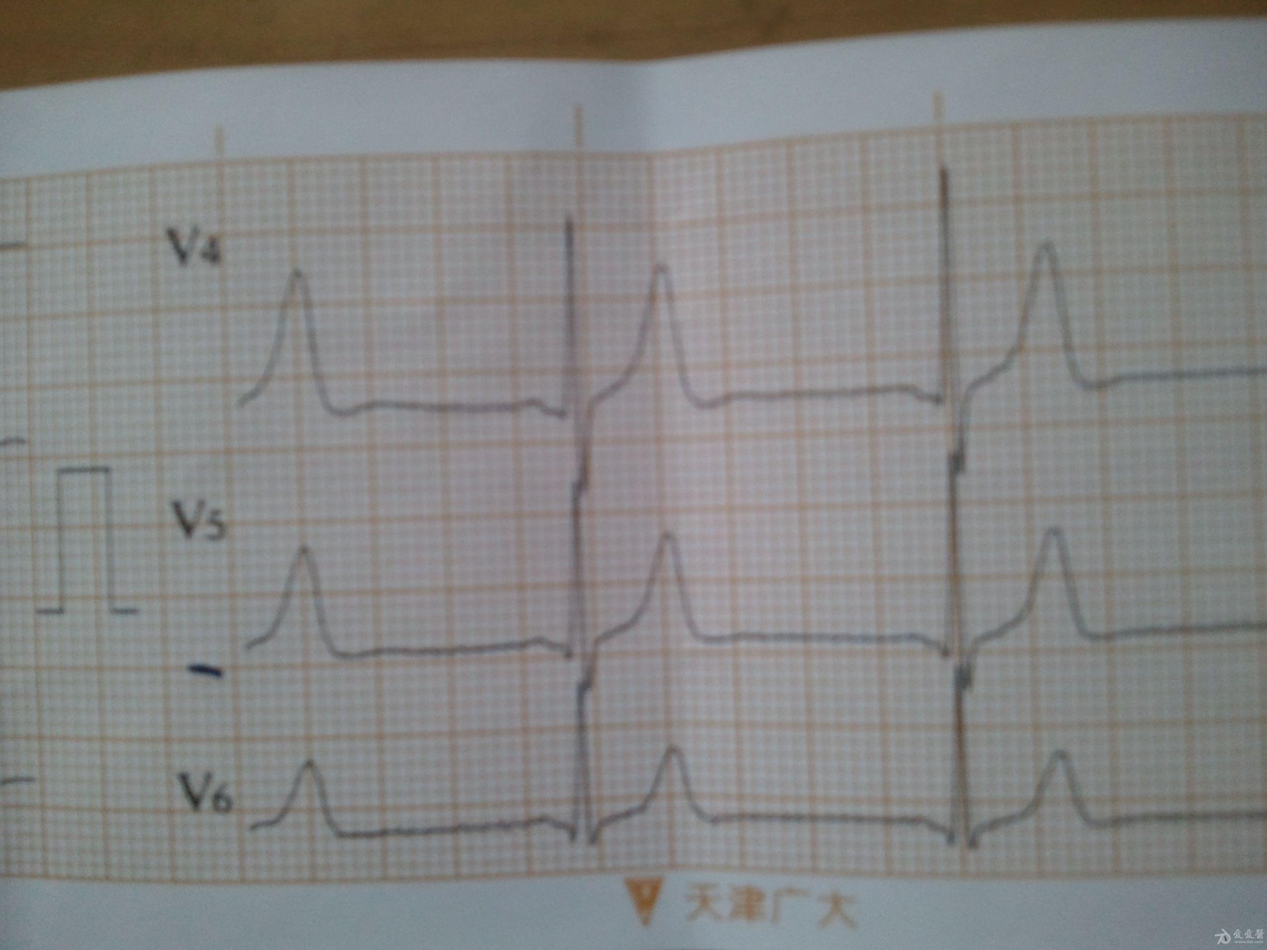 交界性自主心律心电图图片