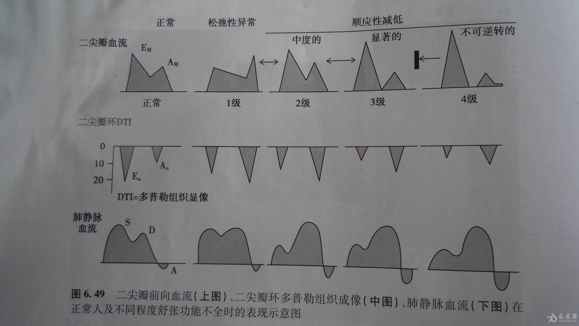 怎样用组织多普勒显像tdi测左室舒张功能伪正常