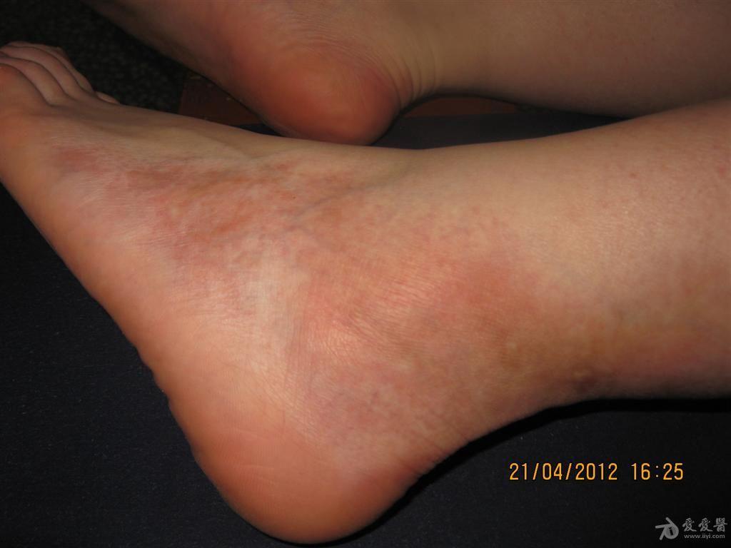 看图识病局限性硬皮病